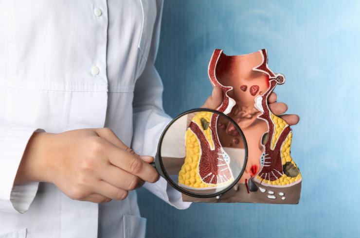 Fistula Treatment image